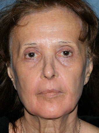 Fraxel Repair in Combination with other lasers yields best results after 149668