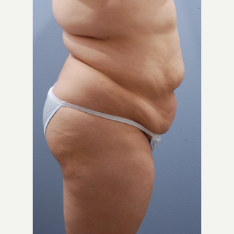 25-34 year old woman treated with Tummy Tuck before 3590391