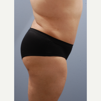 25-34 year old woman treated with Tummy Tuck after 3590391