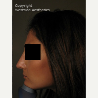 Non Surgical Nose Job to Correct Bump after 3004781