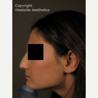 Non Surgical Nose Job to Correct Bump before 3004781