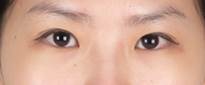 Asian Eyelid Surgery before 1223747