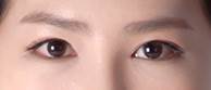 Asian Eyelid Surgery after 1223747