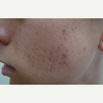 Acne Free RF with eMatrix before 1856300