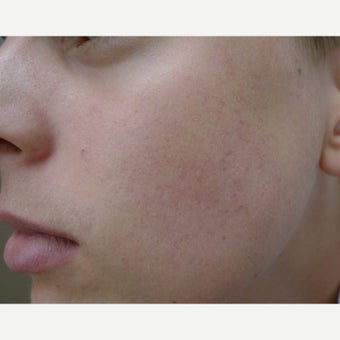 Acne Free RF with eMatrix after 1856300