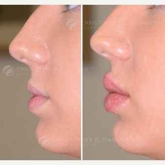 25-34 year old woman treated with Lip Augmentation - same day results before 3626871