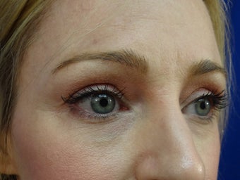 Lower eyelid hyaluronic acid (Restylane) after 908788