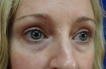 Lower eyelid hyaluronic acid (Restylane) before 908788
