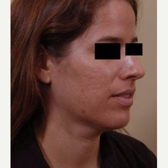 25-34 year old woman treated with Acne Scars Treatment before 3749315