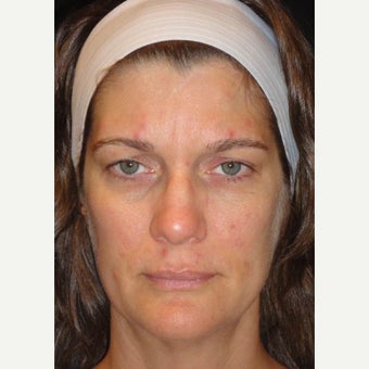 35-44 year old woman treated with Voluma 1626299