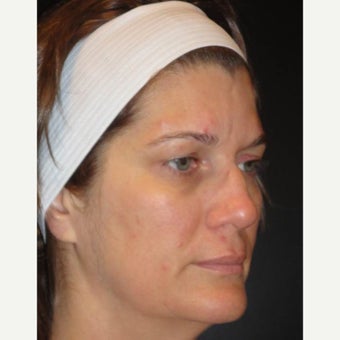 35-44 year old woman treated with Voluma before 1626299