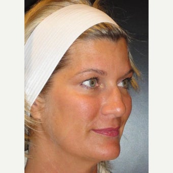 35-44 year old woman treated with Voluma after 1626299