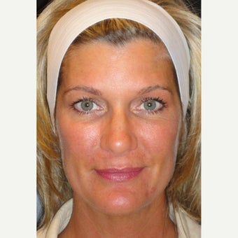 35-44 year old woman treated with Voluma 1626299