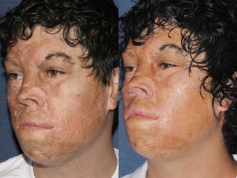 Before & After Laser Resurfacing 806234