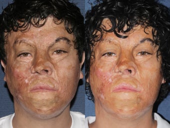 Before & After Laser Resurfacing before 806234