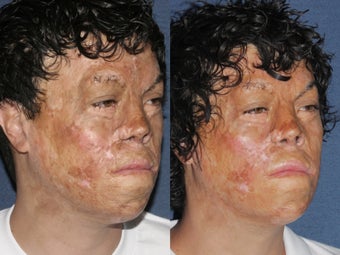 Before & After Laser Resurfacing after 806234