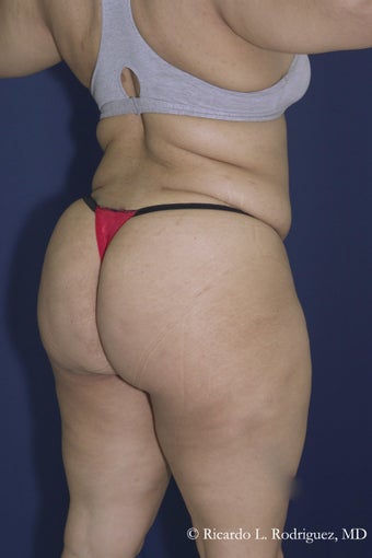 Brazilian Butt Lift after 606611