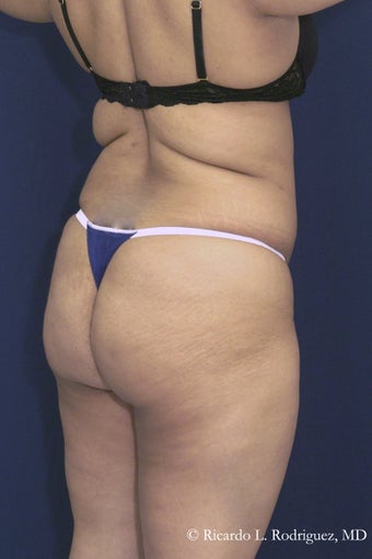 Brazilian Butt Lift before 606611