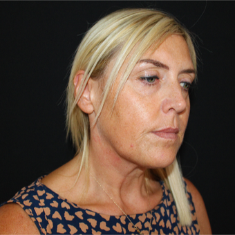 45-54 year old woman treated with Mini Lift before 3535470
