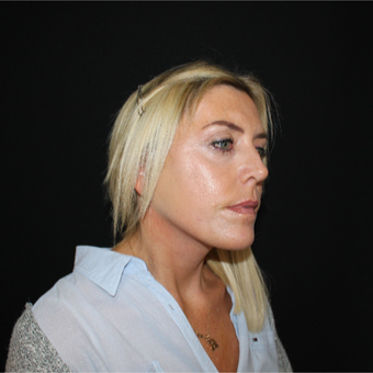 45-54 year old woman treated with Mini Lift after 3535470