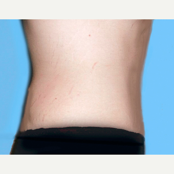 Tummy Tuck after 3813578
