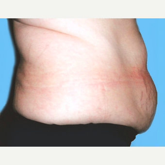 Tummy Tuck before 3813578