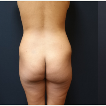 25-34 year old woman treated with Brazilian Butt Lift before 3731865