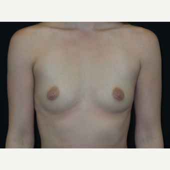 25-34 year old woman treated with Breast Implants before 3652117