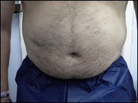 53 Year Old Male Treated with CoolSculpting for abdomen before 1299993