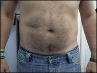 53 Year Old Male Treated with CoolSculpting for abdomen after 1299993