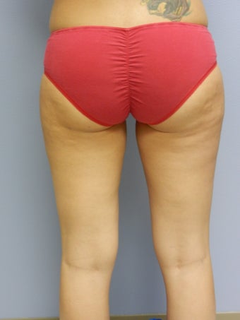Laser Lipo on Outer Thighs after 384799
