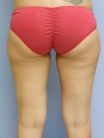 Laser Lipo on Outer Thighs before 384799