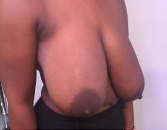 25-34 year old woman treated with Breast Reduction before 3749882