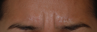 Botox for Glabella "11's" before 1376629