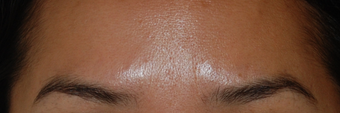 Botox for Glabella "11's" after 1376629