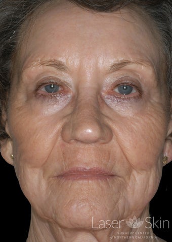 75 and up year old woman treated with CO2 Laser Resurfacing after 1719735