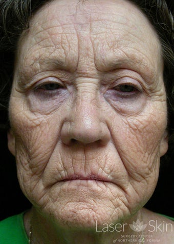 75 and up year old woman treated with CO2 Laser Resurfacing before 1719735