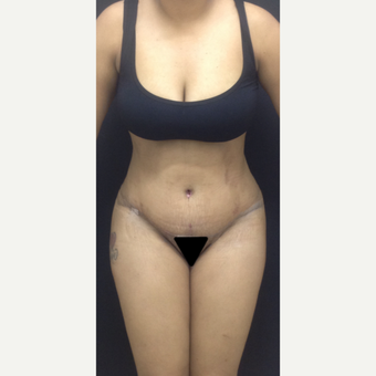 25-34 year old woman treated with Tummy Tuck after 3341247