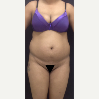 25-34 year old woman treated with Tummy Tuck before 3341247