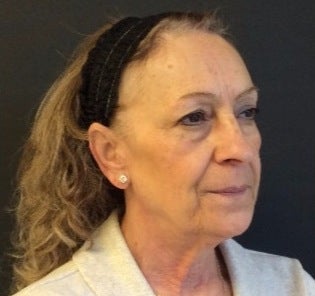 Woman treated with Sculptra to improve laxity and restore facial volume before 2389658