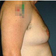 34 year old man treated with Male Breast Reduction before 3720908