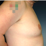 34 year old man treated with Male Breast Reduction after 3720908
