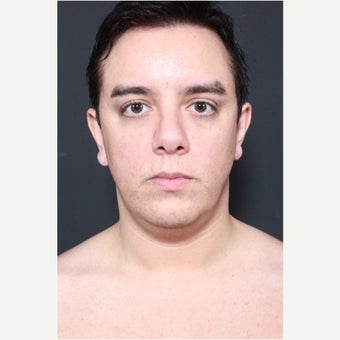 35-44 year old man treated with Neck Lift 1661125