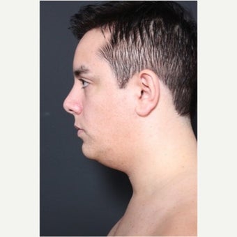 35-44 year old man treated with Neck Lift before 1661125