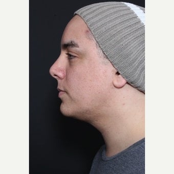 35-44 year old man treated with Neck Lift after 1661125