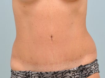 Tummy tuck disaster is saved by secondary pull after 1132549