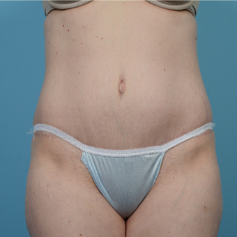 35-44 year old woman treated with Tummy Tuck after 3098298
