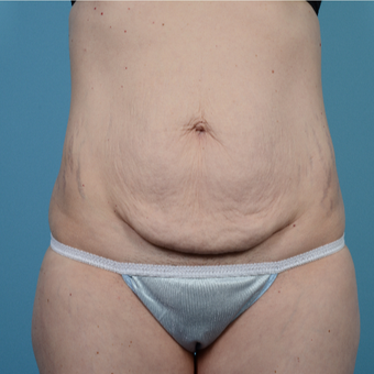 35-44 year old woman treated with Tummy Tuck before 3098298