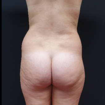 18-24 year old woman treated with Brazilian Butt Lift before 3315449