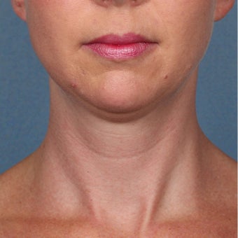 35-44 year old woman treated with Kybella before 2224857